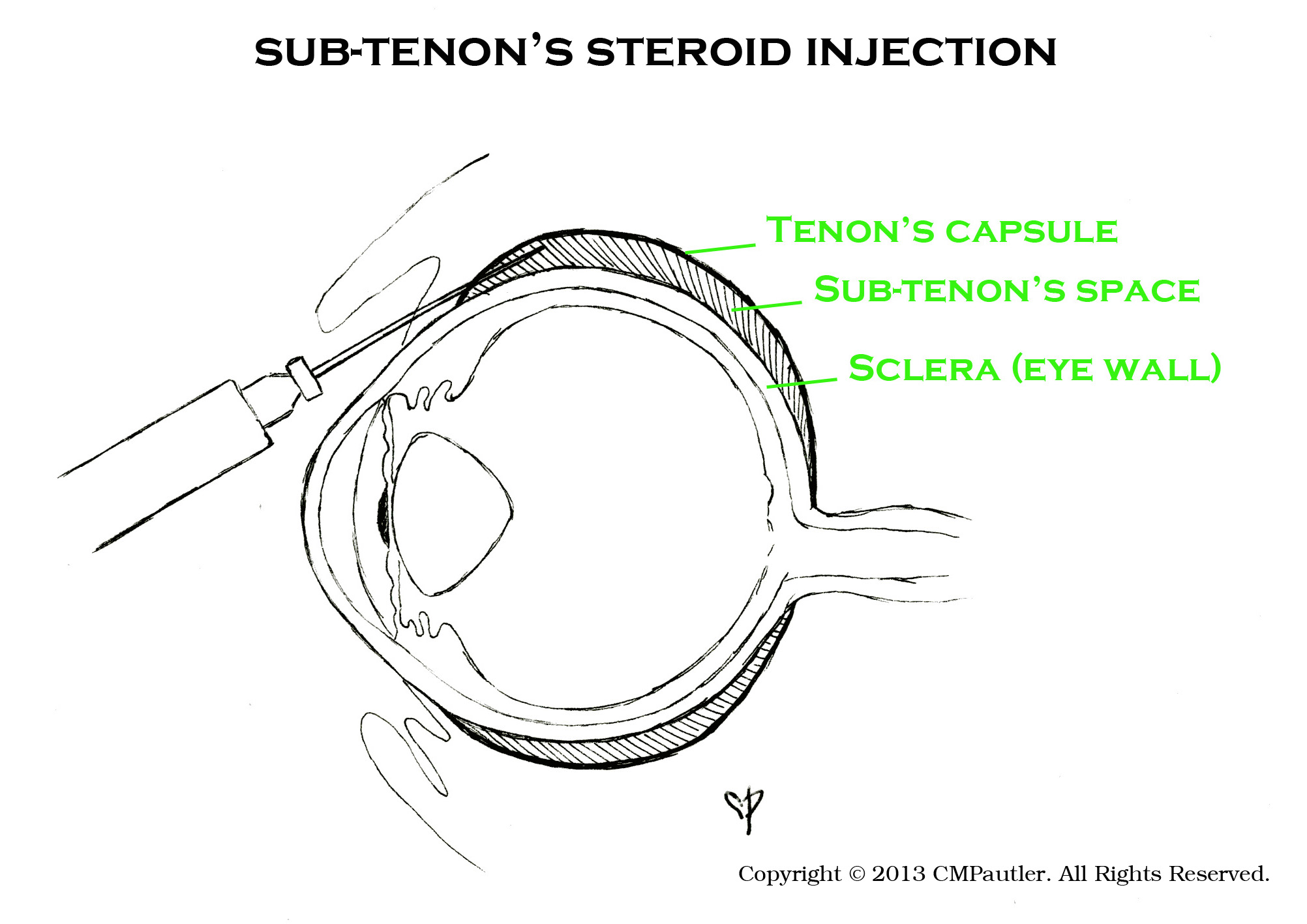 what is sub tenons triamcinolone injection