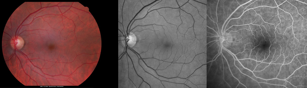Amsler Grid - Retina Test - Retina Specialist - Buffalo New York - Back of  the Eye MD